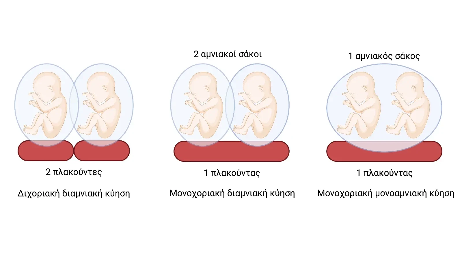 Επιπλοκές μονοχοριακών διδύμων