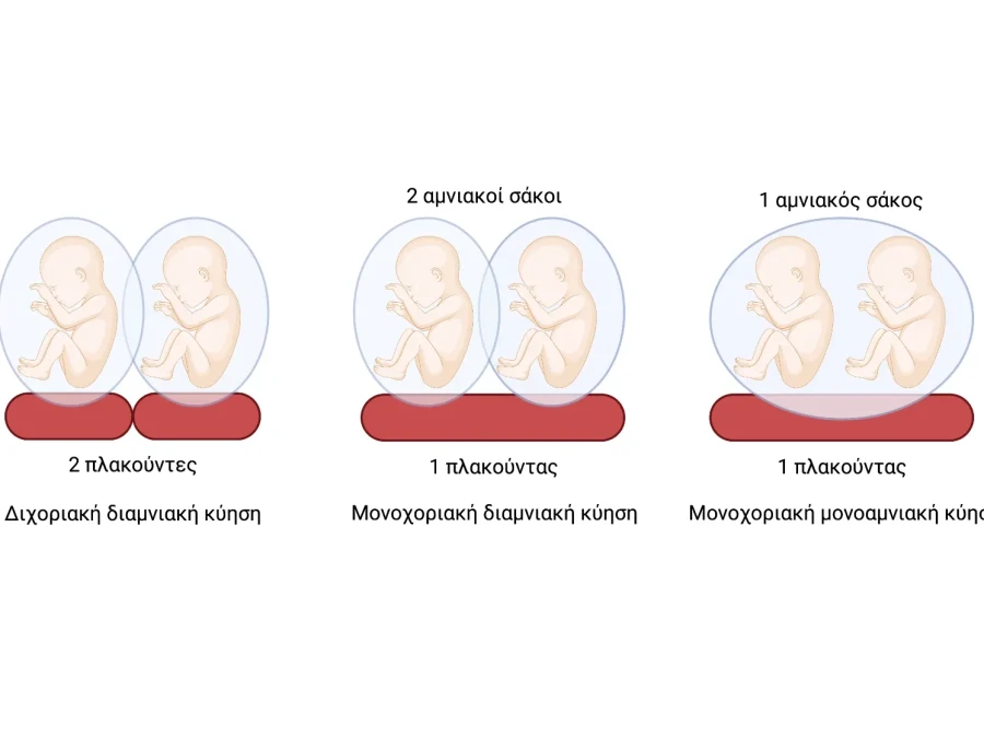 <br />
<b>Warning</b>:  Undefined property: stdClass::$imageAlt in <b>/home/wwwinutero/public_html/templates/webmac/html/mod_articles/default_items.php</b> on line <b>47</b><br />
Επιπλοκές μονοχοριακών διδύμων